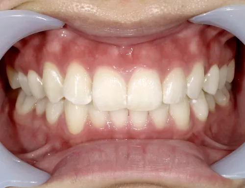 20代女性ホワイトニング施術後の口腔内写真