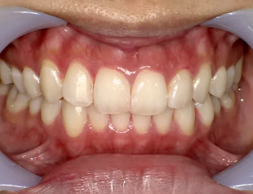 20代女性ホワイトニング施術前の口腔内写真