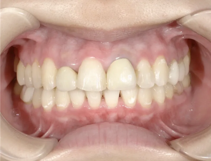 10代女性ホワイトニング施術後の口腔内写真