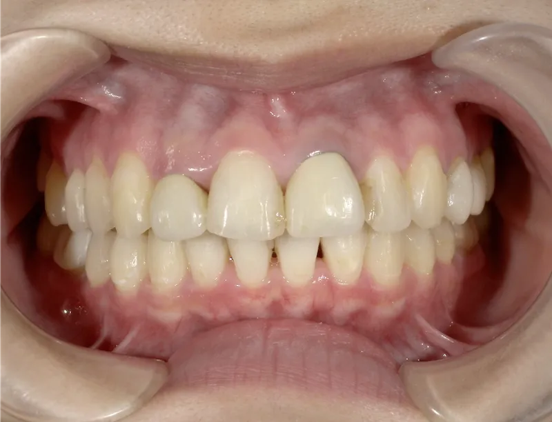 10代女性ホワイトニング施術前の口腔内写真