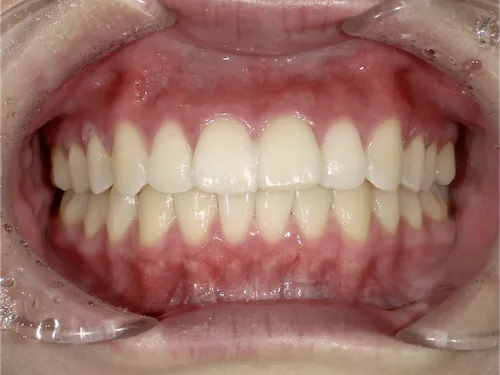 えみはホワイトニング施術後の口腔内写真