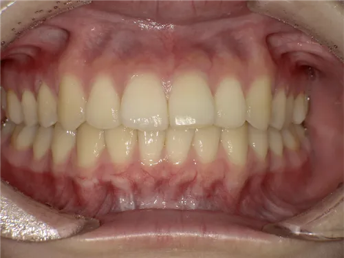 えみはホワイトニング施術前の口腔内写真