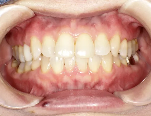 50代女性ホワイトニング施術後の口腔内写真