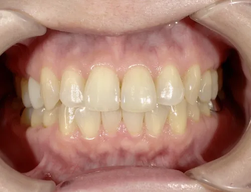 50代女性ホワイトニング施術前の口腔内写真