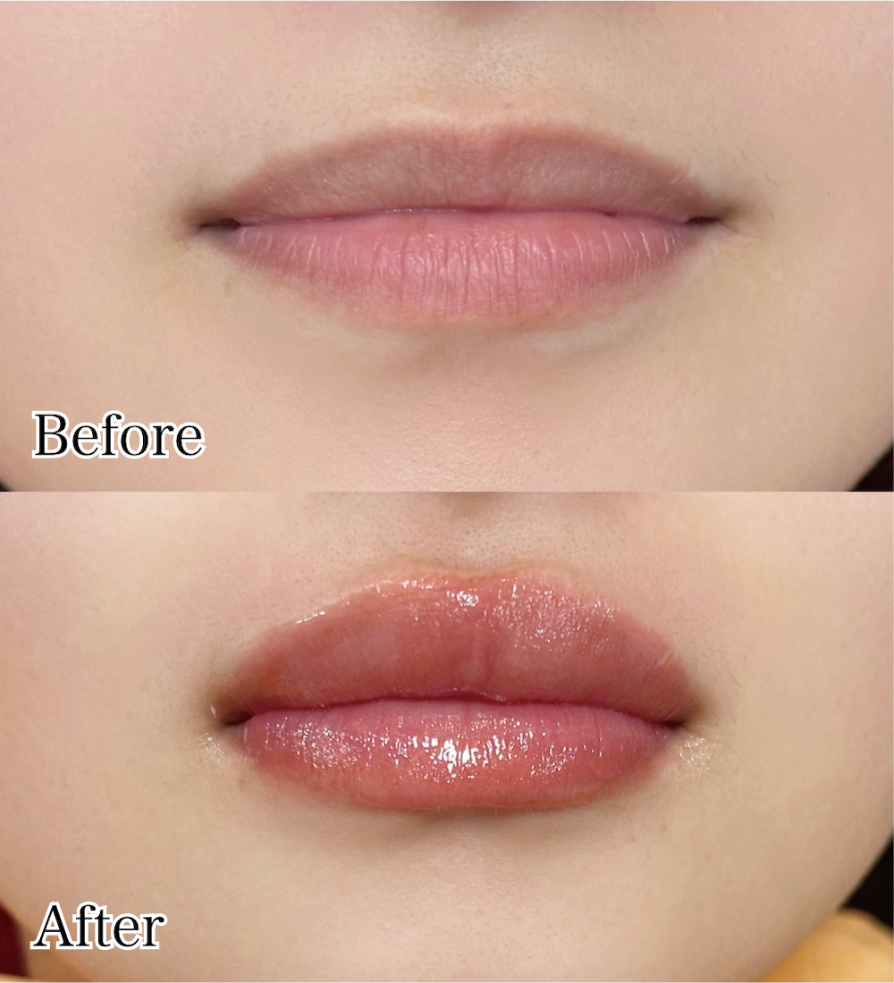 えみはデンタルアンドリップの症例写真