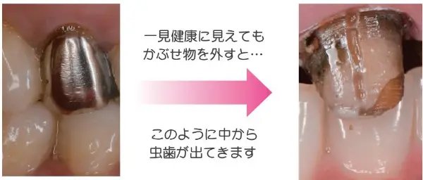 一見健康に見えてもかぶせ物を外すと… このように中から虫歯がでてきます