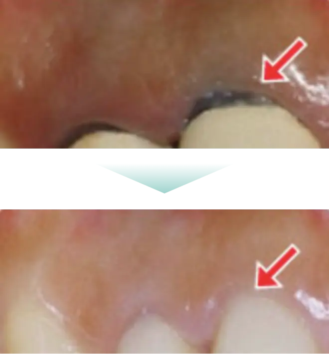 銀歯など金属イオンの溶出によって歯や歯茎が黒ずむ心配もありませｎ