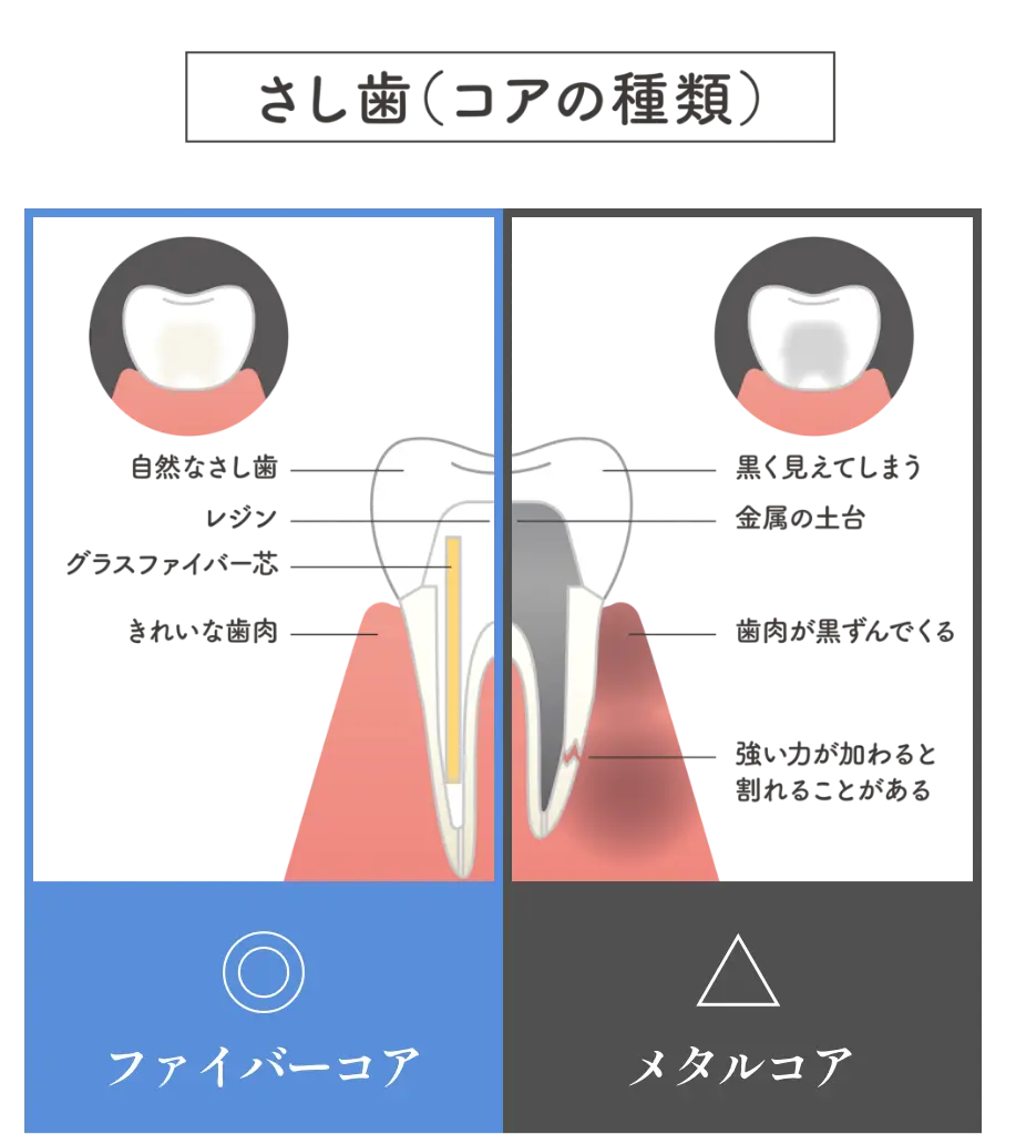 さし歯（コアの種類） ファイバーコア：自然なさし歯、レジン、グラスファイバー芯、きれいな歯肉 メタルコア：黒く見えてしまう、金属の土台、歯肉が黒ずんでくる、強い力が加わると割れることがある